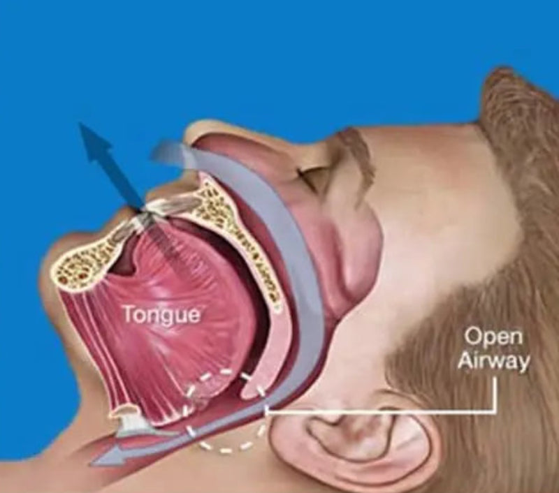 Appareil Anti-Ronflement Ergonomique - Embout en Silicone Médical